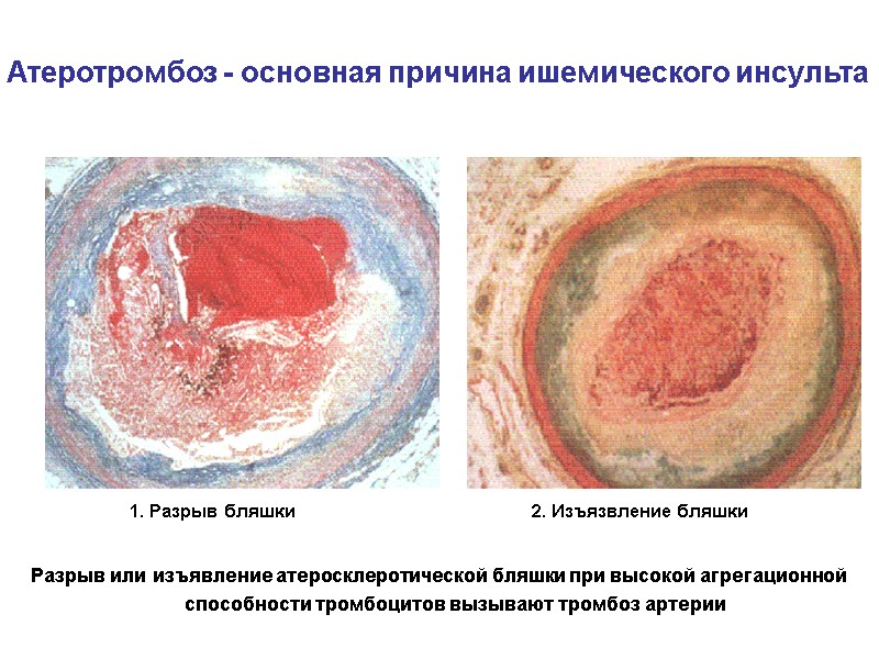 Атеротромбоз - основная причина ишемического инсульта        